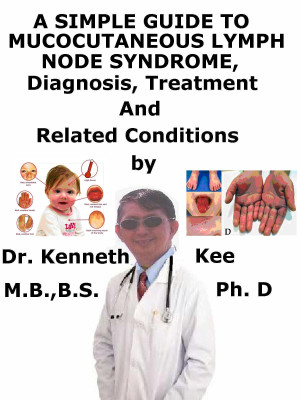 A Simple Guide to Mucocutaneous Lymph Node Syndrome (Kawasaki Disease), Diagnosis, Treatment and Related Conditions